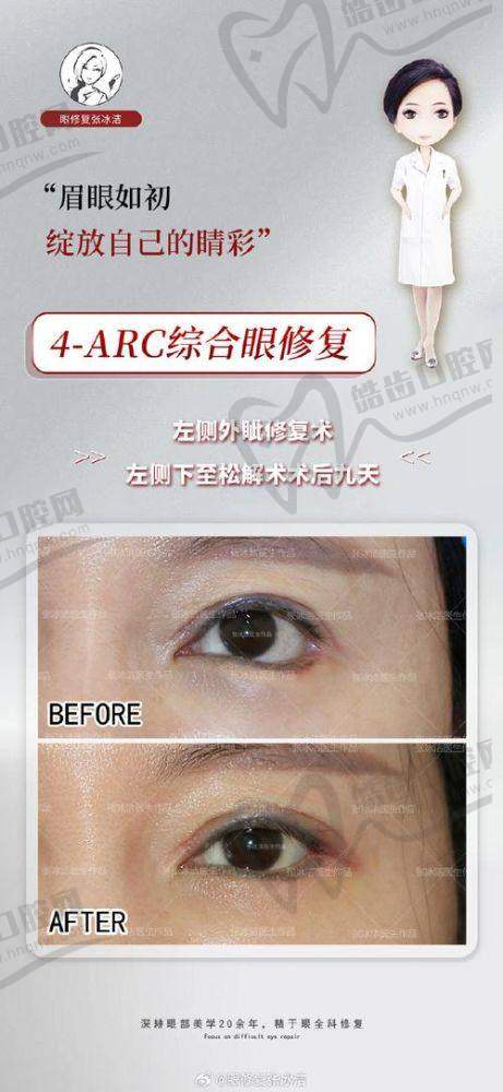 价格参考：双眼皮修复费用透明合理