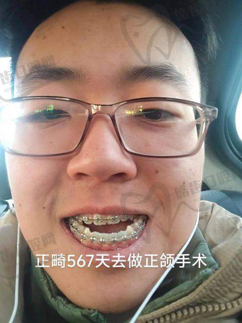 骨性龅牙用3D导板正颌能矫正到什么程度？真实实例说明一切