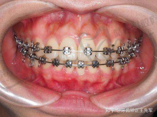 【东莞固德口腔医院怎么样】正规连锁靠谱吗?种植1880元|半口5万|矫正价(2025收费表)