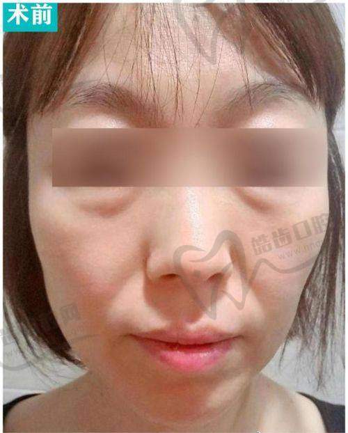 二、太原拉皮整形多少钱（按医院等级划分）
