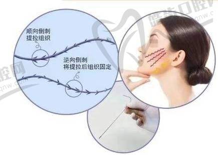 张海明韧带拉皮实例
