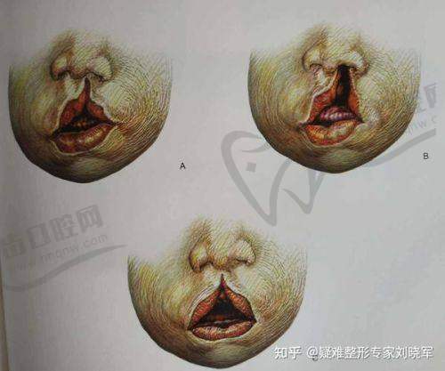 重庆唇腭裂修复去哪家医院好？美仑美奂是不错的选择
