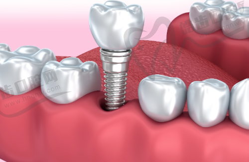 武汉优益佳口腔杨丕波医生,韩国登腾种植牙仅5800元起,种出健康好牙!