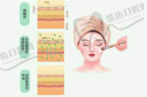 哲晨子玻尿酸的塑形成效分析