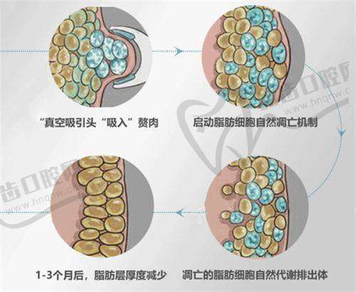 广州艺星乔雅登丰颜玻尿酸8800元起，24个月立体塑形，打造明星级饱满轮廓