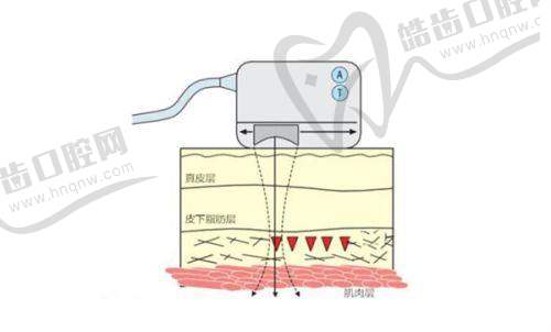 广州艺星王艳医生亲推！伊婉C玻尿酸2800元起，苹果肌嘭弹立体感飙升