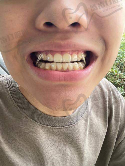 武汉优益佳口腔杨丕波医生,正雅隐形矫正仅16800元起,开启美牙新体验!