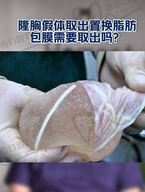取假体脂肪丰胸9万贵吗之刘成胜医生技术优势体现价格价值