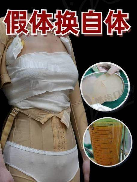 取假体脂肪丰胸9万贵吗之北京京美整形刘成胜医生实例参考