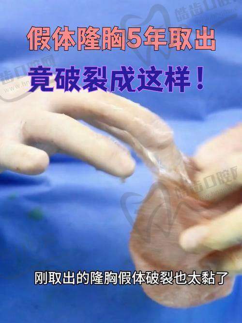 取假体脂肪丰胸9万贵吗之武汉仁爱时光刘成胜医生实例分析