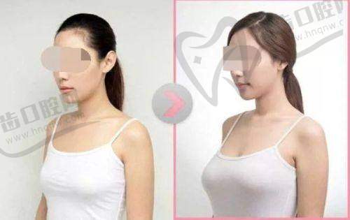 法芮娅隆胸假体价格贵之高端材料与技术加持