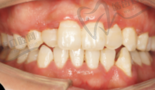 玉林蓝天口腔博白店种植牙项目价格分析