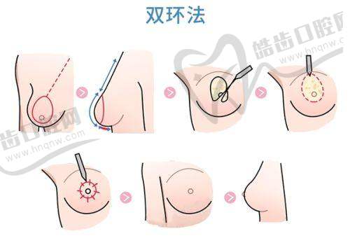 打除皱针眼皮塌下来了多久能修复：需警惕的异常情况