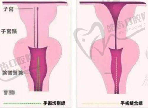 打除皱针眼皮塌下来了多久能修复：情绪支持与风险提示