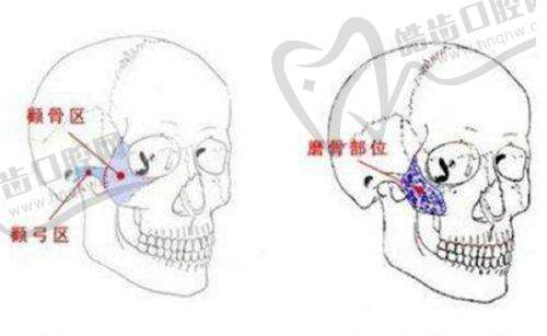 赵映贤医生的双眼皮手术有什么特点？