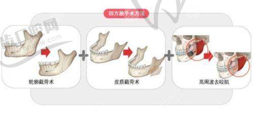 2025北京八大处整形价格一览表：开眼角手术费用高吗？