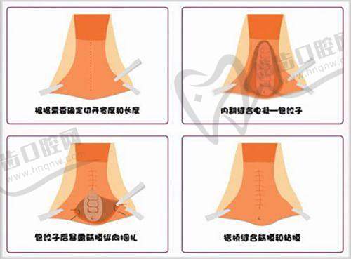 出彩医美十分钟隆胸是真是假及价格：价格注意事项要牢记