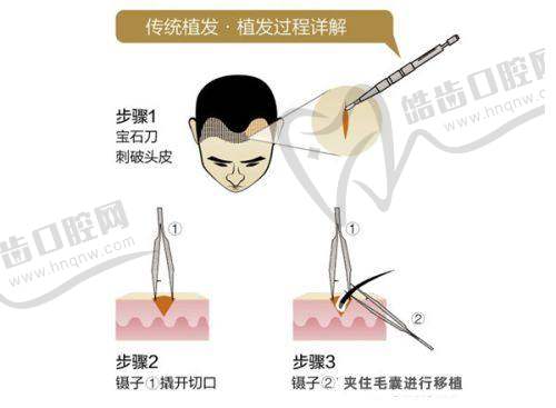 张春杰医生植发技术的显著优势