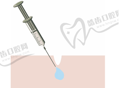 出彩医美十分钟隆胸是真是假及价格：不同假体品牌价格区间