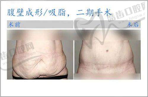 河南郑州华仁植发怎么样？医生团队经验多