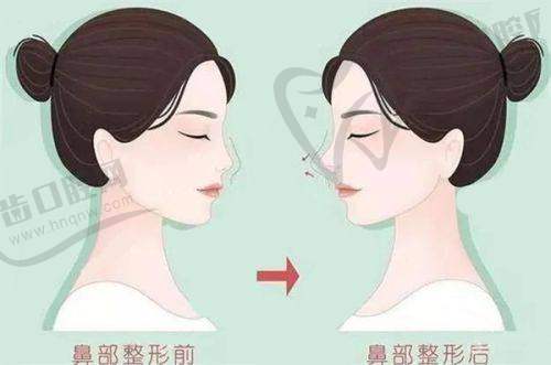 les平胸手术收费价目表查看：常见手术方式及价格