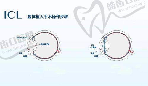 宁波爱尔光明眼科（江北诊所）详细的预约挂号方式及流程