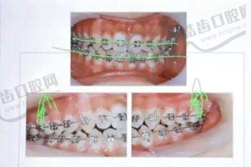 6、金华华康口腔医院种植牙怎么样？