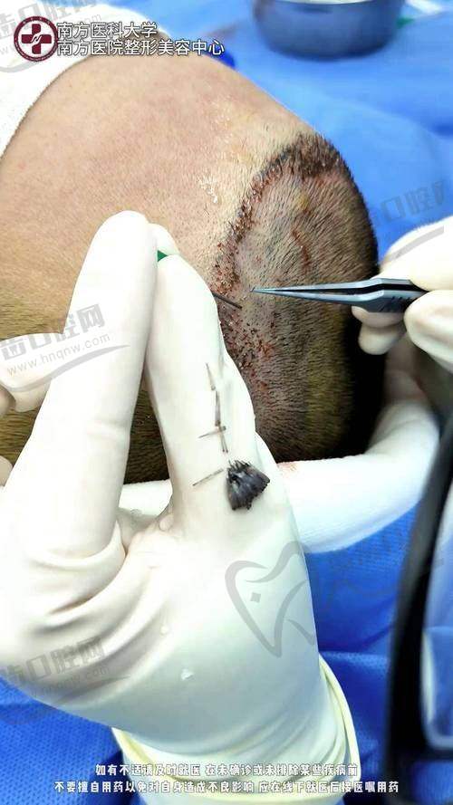 七、梁明成医生2025年植发价格表(元起)