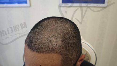 三、梁明成医生技术水平高:五大核心优势引领行业标准