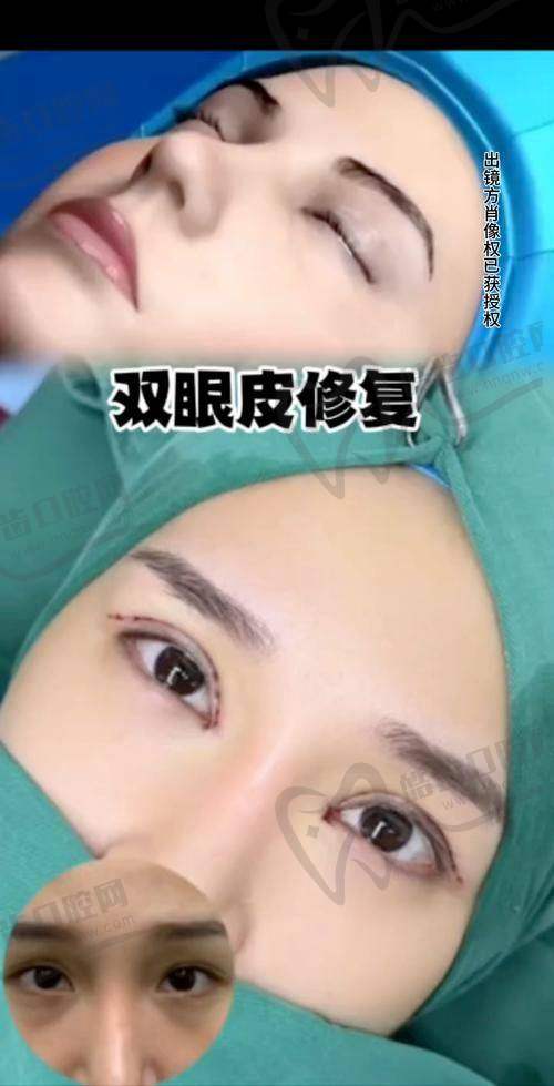 上海张楚做全切 + 眼角修复的价格考量
