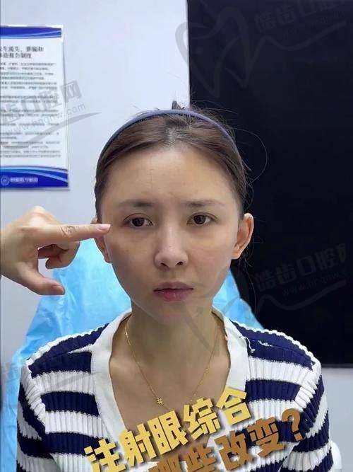 耳基底提升注射的作用