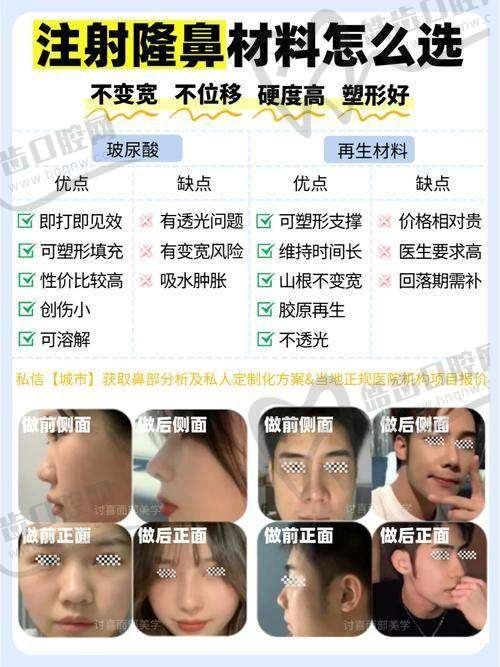 花3万5找上海岳伟注射骨雕鼻，比鼻综合更放心！三大优势+高性价安心变美 