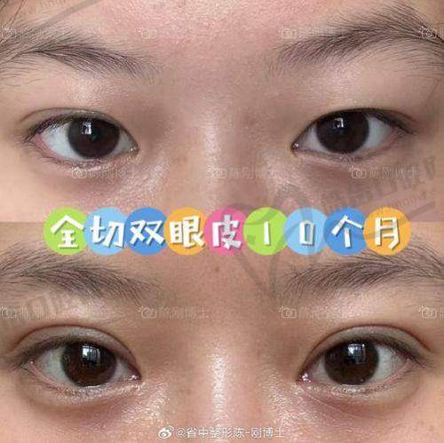 徐刚强医生手术费用详情