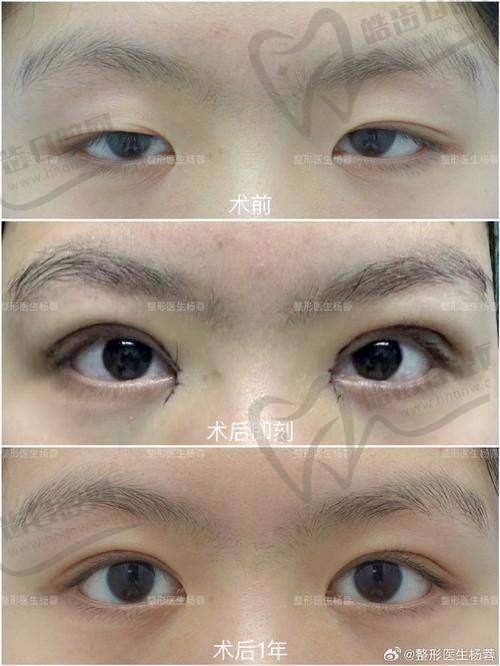 从审美风格看王莉莉双眼皮设计偏好：偏自然派，更注重协调感