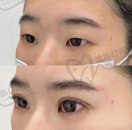 哪些人群适合找王莉莉医生做双眼皮/修复手术？