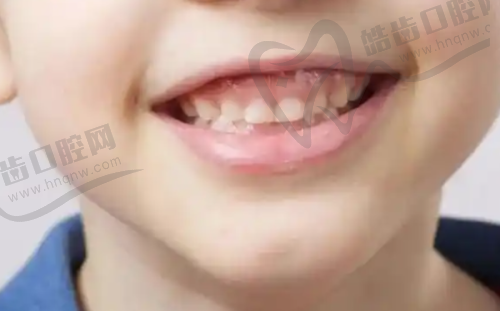 2025年香港睇牙医更新价目表大公开:洗牙补牙根管治疗收费怎样?