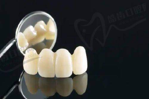 2025年香港睇牙医更新价目表大公开:全瓷牙冠及相关项目收费如何?