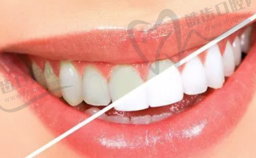 2025年香港睇牙医更新价目表大公开:拔牙手术费用高吗?