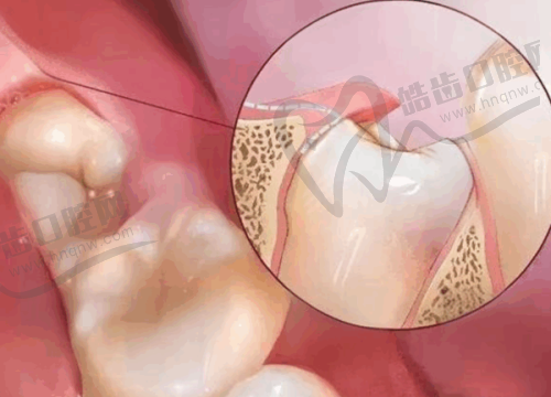 2025年香港睇牙医更新价目表大公开:义齿修复收费情况如何?