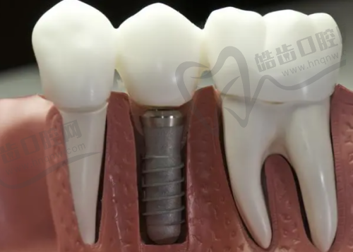 二、香港vs深圳口岸牙醫點揀?關鍵睇呢3點!