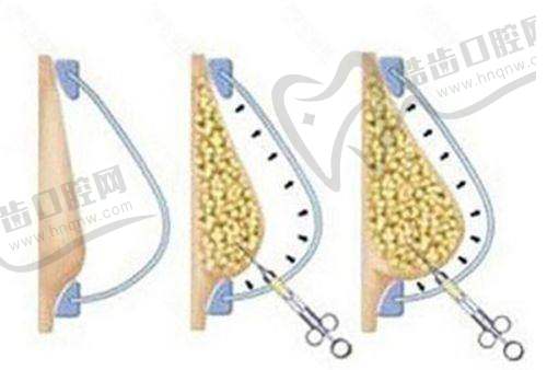 上海赛米医疗美容腿部抽脂价格