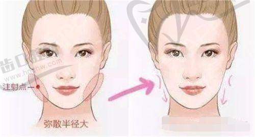 李曉東拉皮手術(shù)怎么樣？PST/PSV面部提升原理、效果、價(jià)格攻略，面部松弛下垂別錯過