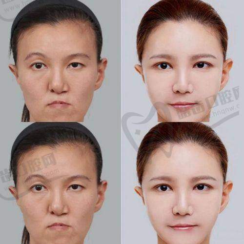 李方奇面部减容三件套实际体验分享：不是所有脸大都贵