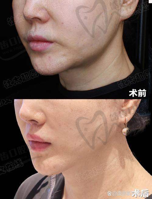 李方奇医生技术如何？术后评价咋样？
