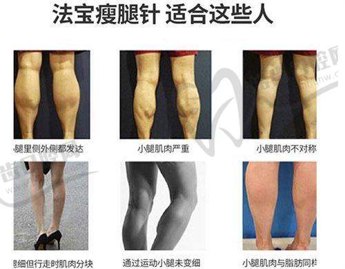 紧缩针都有哪几种品牌之羽禅私密紧缩针