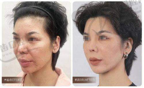 歌莉兰紧缩针价格之医院与医生资质影响