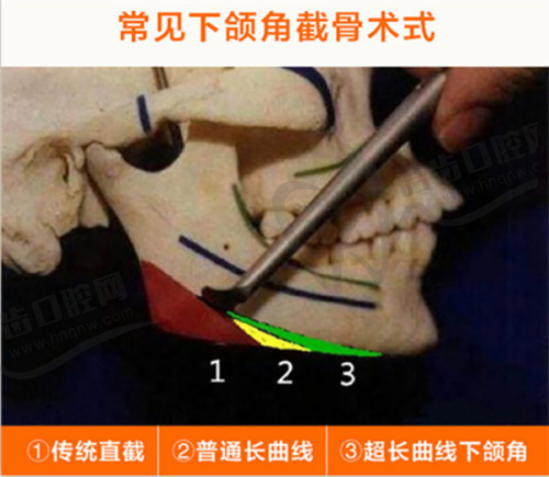 润蕾雅医用I型胶原无菌凝胶的使用建议总结