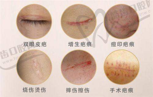 润蕾雅医用I型胶原无菌凝胶的产品成效分析