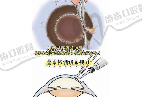上海新视界眼科医院于妍娉医生