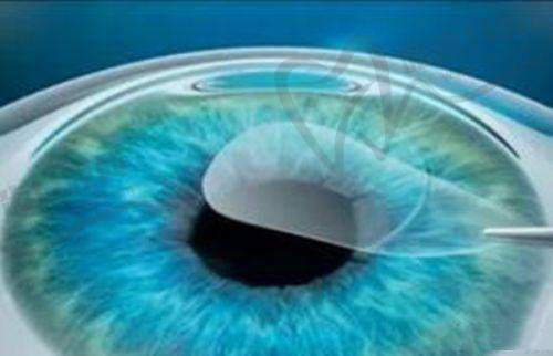 上海做近视眼手术的医院——上海黑马眼科医院